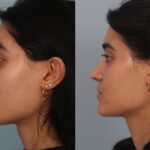 rhinoplasty-merged-41