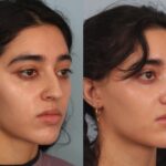 rhinoplasty-merged