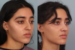 before and after rhinoplasty