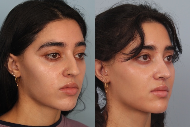 before_after_img
