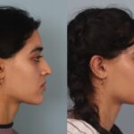 rhinoplasty-merged