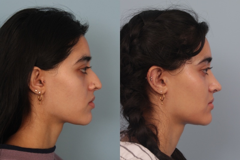 before_after_img
