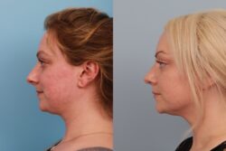 before and after rhinoplasty