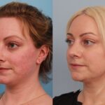 rhinoplasty-merged