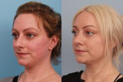 before and after rhinoplasty