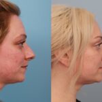 rhinoplasty-merged