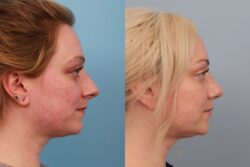 before and after rhinoplasty