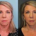Facelift Necklift & CO2 Eyes