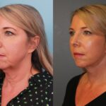 Facelift Necklift & CO2 Eyes Oblique