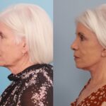 brow-lift-merged