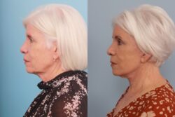 before and after brow lift