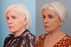 before and after brow lift
