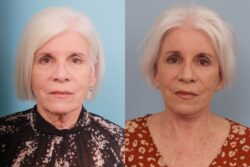 before and after brow lift