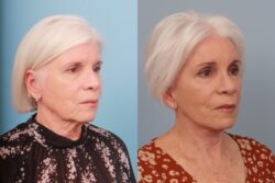 before and after brow lift