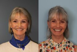 before and after facelift