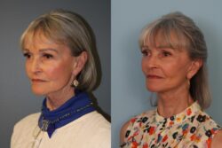 before and after facelift