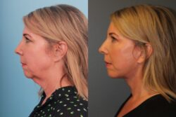 before and after facelift