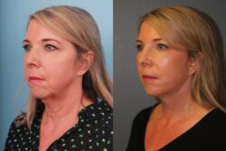 before and after facelift