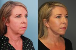 before and after facelift