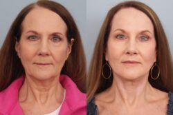 before and after facelift