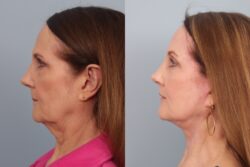before and after facelift