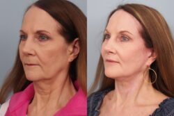 before and after facelift