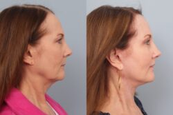 before and after facelift
