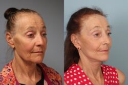 before and after facelift