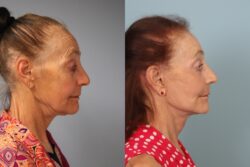 before and after facelift