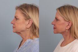 before and after facelift