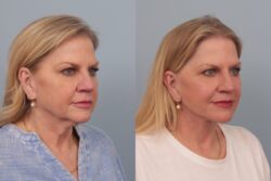 before and after facelift