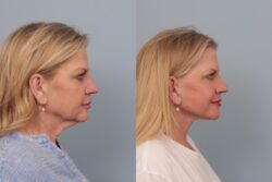 before and after facelift