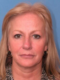 before forehead lift