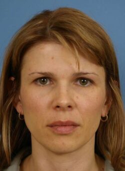 before forehead lift