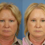 forehead-lift-merged