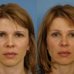 forehead-lift-merged