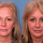 forehead-lift-merged