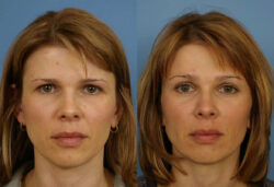 before and after forehead lift