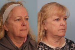 before and after mixto