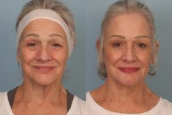 before and after mixto