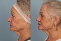 before and after mixto