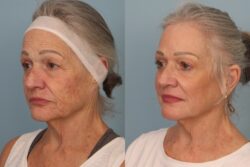 before and after mixto