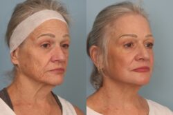 before and after mixto