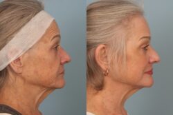 before and after mixto