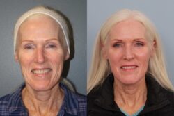 before and after mixto