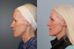 before and after mixto