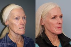 before and after mixto