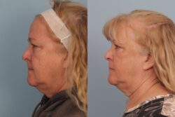 before and after mixto