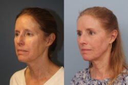 before and after mixto