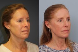 before and after mixto